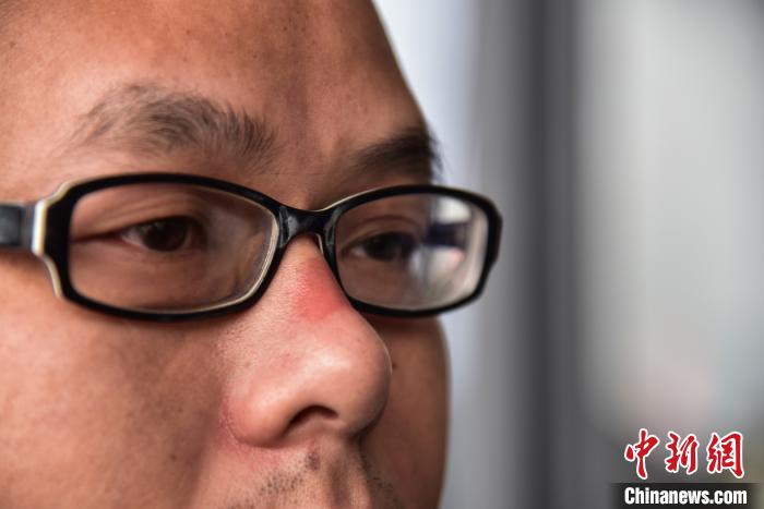一次6小时的执勤后，工作人员的鼻子都会被呼吸面罩压出红色的血印子。　王以照 摄